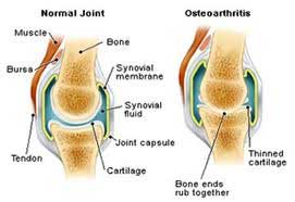 Osteoarthritis Treatment Doctor | Brooklyn | New York City (NYC)